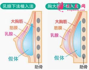 假体隆胸后会痛多长时间