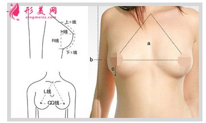 假体隆胸价格费用是多少