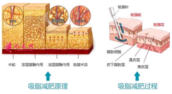 吸脂减肥过程痛不痛