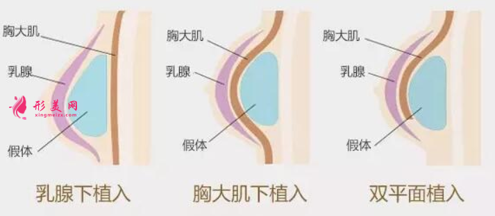 假体隆胸型号怎么选择