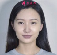 郑州附二院杨丽双眼皮修复效果如何？真人案例分享