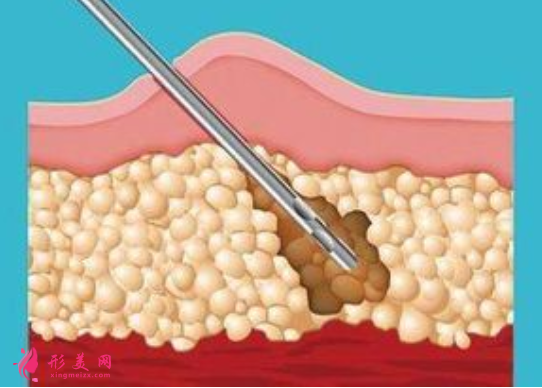 腰腹部吸脂术后护理要注意什么