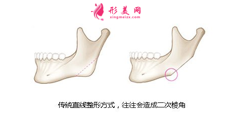 传统下颌角手术