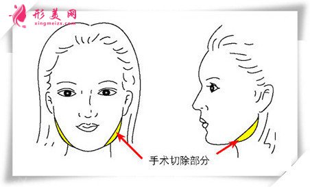 下颌角手术部位