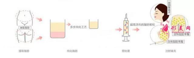 自体脂肪填充流程