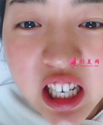 北京友谊医院口腔科怎么样？牙齿矫正案例及价格表公布啦！