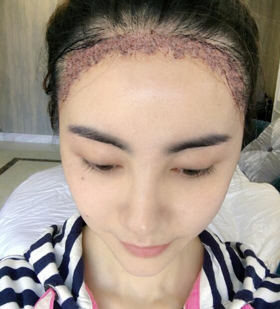 种植头发恢复过程真实案例——南京明基医院